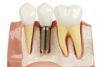 Dental Implants Malvern - Citra Dental Group image 1
